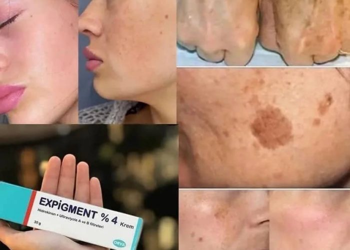 Image annonce: Crême expigment 4%